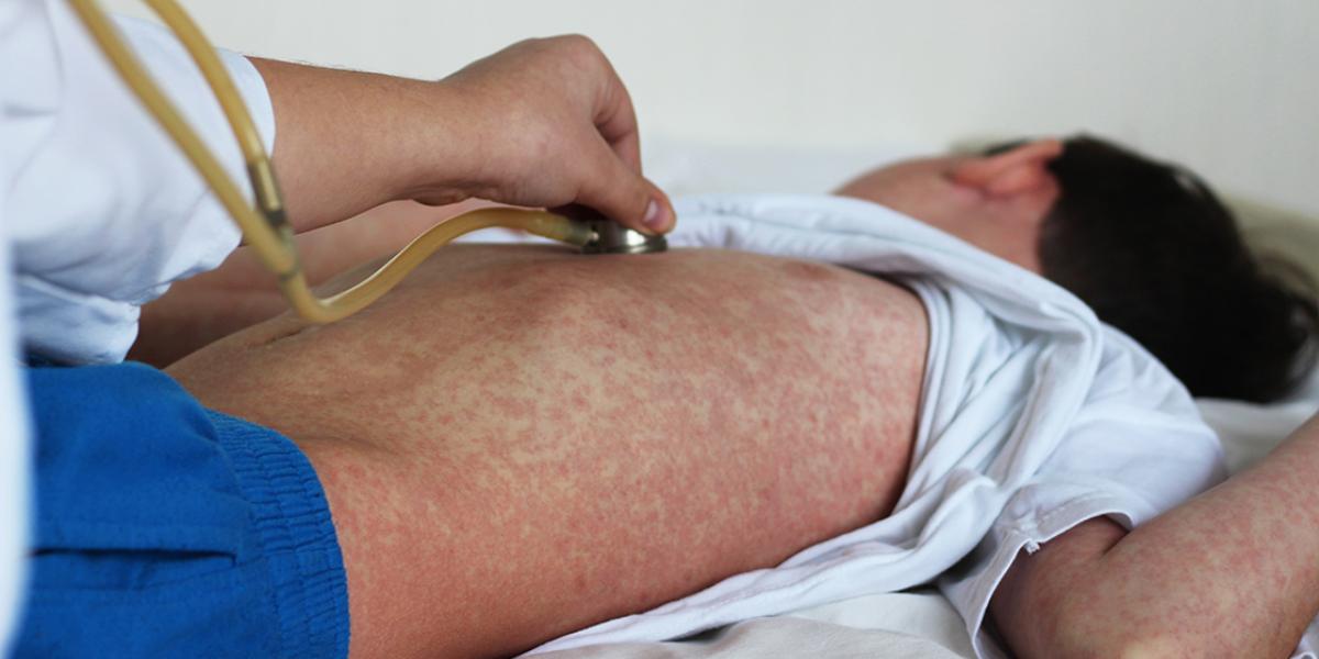 Ministry of Health Issues Warning on Global Measles Increase