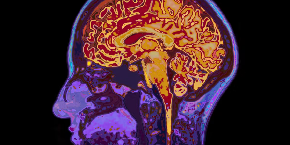 El implante N1 de Neuralink busca registrar señales cerebrales asociadas con la intención de hablar para convertirlas en