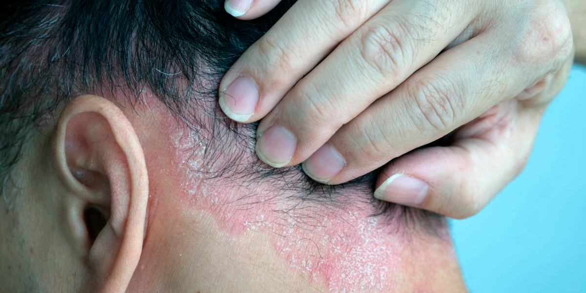 Up to 2.5 million people in Mexico have psoriasis, but few get biologics