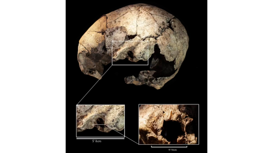 Cráneo de la mujer de El dolmen de El Pendón con cirugía en ambos temporales. Díaz-Navarro, S., Tejedor-Rodríguez, C., Arcusa-Magallón, H. et al. The first otologic surgery in a skull from El Pendón site (Reinoso, Northern Spain). Sci Rep 12, 2537 (2022)