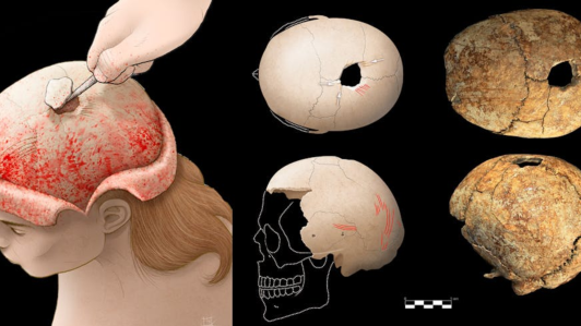 Cráneo trepanado recuperado en la fosa sepulcral de La Saga (Cáseda, Navarra) e ilustración de la técnica empleada.