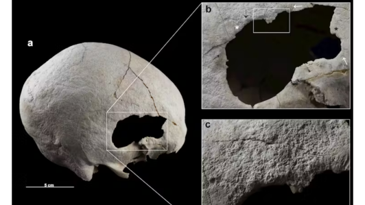 Cráneo trepanado recuperado en el enterramiento calcolítico de Camino del Molino (Caravaca de la Cruz, Región de Murcia).