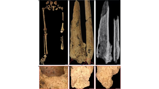 Evidencia de amputación de extremo distal de tibia y peroné izquierdo en un yacimiento de Borneo datado hace 31 000 años. Buquet-Marcon, C., Philippe, C. & Anaick, S. The oldest amputation on a Neolithic human skeleton in France.