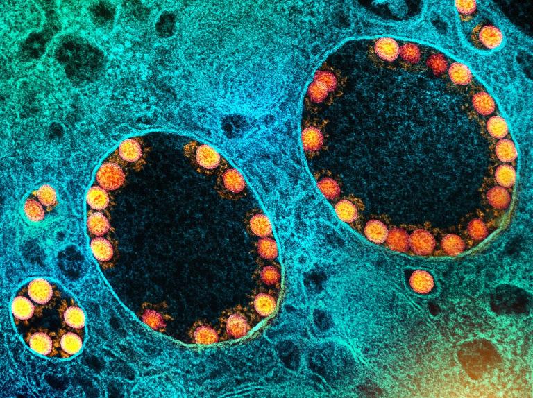 Partículas del virus SARS-CoV-2 (en amarillo) dentro de los endosomas de una célula epitelial nasal  muy infectada. Foto: National Institute of Allergy and Infectious Diseases (NIAID)