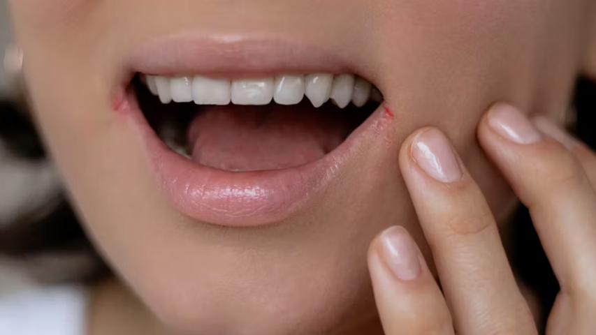 Una vez que una persona ha contraído una infección por herpes.