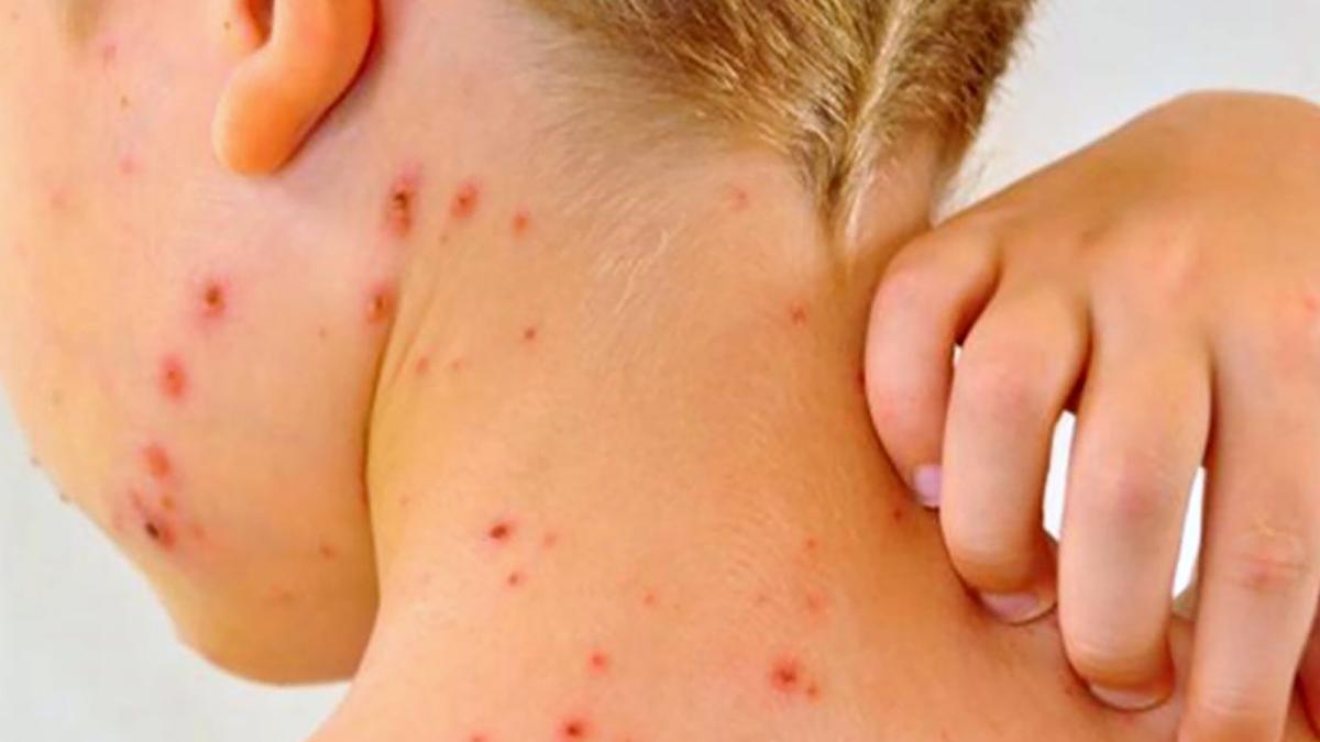 Sarampión: qué es, síntomas, cómo se contagia y posibles complicaciones