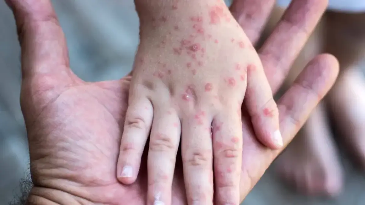 Sarampión en México: Aumentan a 34 las muertes y superan 12,000 los contagios