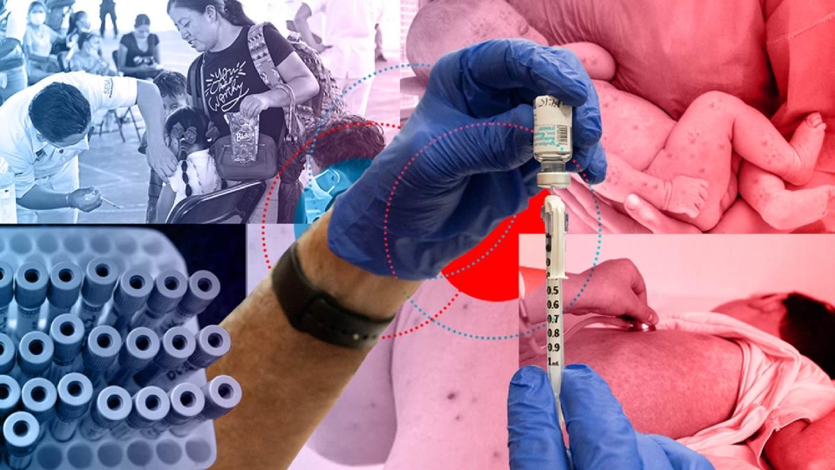 Sarampión en México: Salud reporta más de 8,000 casos y 27 defunciones a un año del primer brote