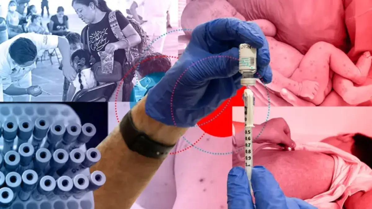 Van 418 casos confirmados de sarampión en la CDMX