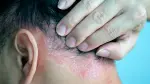 Psoriasis.