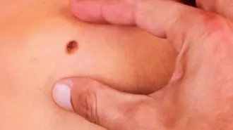 Tumores con mutación.