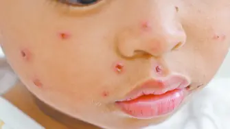 La vacuna es altamente efectiva, ya que previene la infección con 97% de efectividad con 2 dosis, que comienza a partir de las 2 o 3 semanas de haber sido aplicada