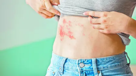 Cualquier persona que haya tenido varicela, tiene este virus “dormido” en su sistema nervioso.