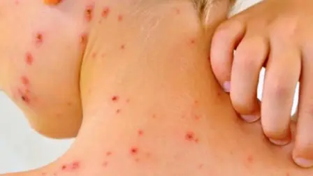 Hasta el 8 de agosto se habían confirmado 10,139 casos de sarampión y 18 muertes relacionadas en 10 países de las Américas, lo que representa un aumento de 34 veces en comparación con el mismo período de 2024.

Para más información del tema, visita: https://www.eleconomista.com.mx/los-especiales/salud/brote-sarampion-america-norte-ops-alerta-aumento-casos-20250815-772889.html

¡Síguenos en nuestras redes sociales para mantenerte informado!

Twitter: https://twitter.com/eleconomista 
Facebook: https://www.facebook.com/ElEconomista.mx
Instagram: https://www.instagram.com/eleconomistamx
LinkedIn: https://www.linkedin.com/company/el-economista/
T

#ElEconomista #EETV