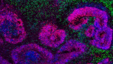 ejido cerebral humano en desarrollo con estructuras en roseta (rosa y azul) rodeadas de neuronas (verde).