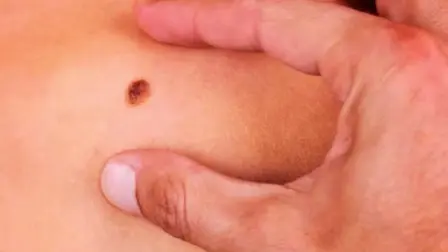 Tumores con mutación.