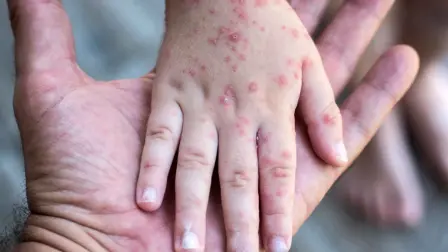 Durante la octava semana epidemiológica de 2026 se contabilizaron 346 casos probables y 9 confirmaciones adicionales, lo que refleja que la transmisión del virus persiste en el país. 

Para más información del tema, visita: https://www.eleconomista.com.mx/politica/mexico-registra-11-266-casos-sarampion-estados-contagios-muertes-20260226-801837.html

¡Síguenos en nuestras redes sociales para mantenerte informado!

Twitter: https://twitter.com/eleconomista 
Facebook: https://www.facebook.com/ElEconomista.mx
Instagram: https://www.instagram.com/eleconomistamx
LinkedIn: https://www.linkedin.com/company/el-economista/

#ElEconomista #Sarampión