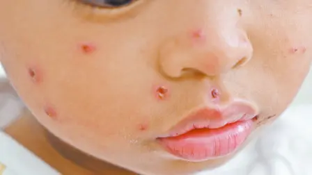 La vacuna es altamente efectiva, ya que previene la infección con 97% de efectividad con 2 dosis, que comienza a partir de las 2 o 3 semanas de haber sido aplicada