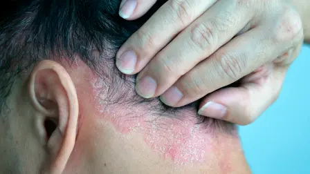 Psoriasis.