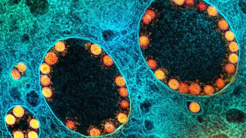 Partículas del virus SARS-CoV-2 (en amarillo) dentro de los endosomas de una célula epitelial nasal  muy infectada. Foto: National Institute of Allergy and Infectious Diseases (NIAID)